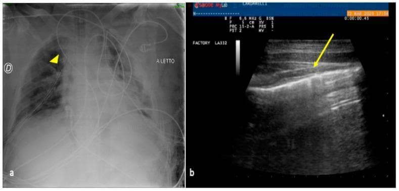 This dual-panel image demonstrates a comparison between chest X-ray (CXR) and lung ultrasound (LUS) in the diagnosis of a residual pneumothorax following major trauma. Image (a) is an anteroposterior bedside CXR showing a surgical drainage tube (arrowhead) in the right hemithorax. While the tube is visible as a radiopaque line, the presence and extent of residual air in the pleural space are difficult to assess. Image (b) is a corresponding lung ultrasound showing a diagnostic 'lung point' (indicated by the yellow arrow). This specific sonographic sign represents the transition zone between a pneumothorax (where the pleural sliding and A-lines are absent) and the normal lung (where visceral and parietal pleurae meet). The LUS image displays the hyperechoic pleural line and regular horizontal A-line artifacts, with the arrow highlighting the point of contact between the aerated lung and the pleural air pocket. This comparison highlights the superior sensitivity of bedside ultrasound over plain radiography for monitoring pneumothorax in critically ill patients.