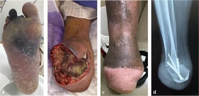 This composite series of four images documents the clinical progression and surgical management of a severe diabetic foot infection and necrotizing gangrene. Panel (a) is a clinical photograph of the plantar surface of the foot showing dry and wet gangrene with extensive tissue necrosis affecting the 2nd, 3rd, and 4th digits, along with surrounding erythema and purulent exudate indicative of advanced infection. Panel (b) shows the postoperative state after a Chopart joint transection, featuring a large, open granulating wound with exposed deep tissues. Panel (c) illustrates the healed outcome following a Pirogoff amputation, showing a shortened, weight-bearing stump with a stable skin graft or healed plantar flap. Panel (d) is a lateral plain radiograph of the same site, demonstrating the modified Pirogoff technique where the calcaneus is rotated and fused to the distal tibia. The radiograph confirms arthrodesis and stable internal fixation with three cannulated compression screws. This sequence is representative of salvage procedures for the diabetic foot to preserve functional weight-bearing length and avoid transtibial amputation.