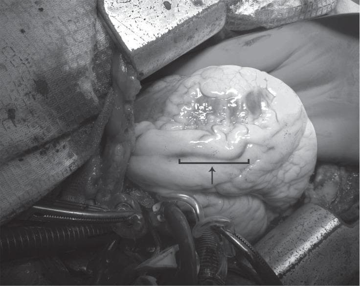 This intraoperative clinical photograph captures a surgical view of a human heart during an emergency coronary artery bypass graft (CABG) procedure. The heart is in a state of cardiac arrest, appearing pale and displaying a wrinkled, non-smooth surface texture consistent with the administration of cold cardioplegia. An arrow and bracket indicate a specific segment of the left anterior descending (LAD) artery, identifying the site of a coronary artery dissection that extends from the left main coronary artery (LMCA). In the foreground and surrounding the heart, several surgical instruments are visible, including metallic clamps and forceps, along with surgical cannulae and tubing used for cardiopulmonary bypass. The image demonstrates the surgical presentation of a Type B coronary dissection requiring urgent revascularization. This visual serves as an educational reference for cardiothoracic surgeons and medical students to understand the gross appearance of coronary pathology and the intraoperative environment during major cardiac surgery.