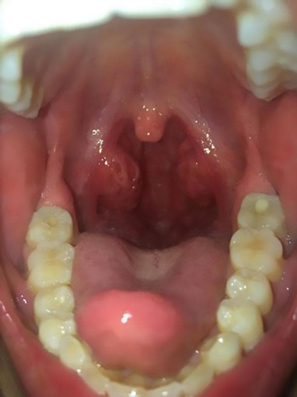 This clinical photograph displays an intraoral view of the oropharynx, highlighting a case of severe acute tonsillitis. The primary findings include significant bilateral tonsillar hypertrophy, with the palatine tonsils appearing markedly swollen and erythematous. Multiple small, white-to-yellowish purulent exudates are visible within the tonsillar crypts, a hallmark of bacterial infection. The surrounding oropharyngeal mucosa and soft palate exhibit generalized hyperemia. The uvula is midline and appears slightly edematous but not deviated. Other visible anatomical landmarks include the tongue and the maxillary and mandibular dentition. This visual representation is characteristic of infectious processes such as Lemierre syndrome precursors or streptococcal pharyngitis, demonstrating clinical signs that can lead to airway narrowing or systemic inflammatory response syndrome (SIRS).