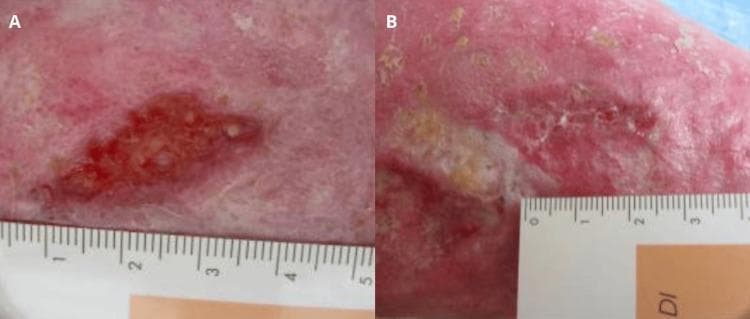 Clinical photograph comparison of a venous leg ulcer on the lower limb of an 85-year-old patient, showcasing therapeutic progression over one month. Image A (Baseline): A large, irregularly shaped ulcer with a dark red, granular wound bed and defined margins. The surrounding periwound skin exhibits significant erythema and signs of chronic venous insufficiency, such as lipodermatosclerosis or post-phlebitic changes. Image B (One-month follow-up): The same anatomical region demonstrates significant wound healing. The ulcer has markedly decreased in size and depth. The wound bed has transitioned to a lighter pink hue, indicating the formation of healthy granulation tissue and re-epithelialization from the periphery. The surrounding skin integrity is improved, with reduced inflammatory erythema and a more uniform texture. Both images include a medical ruler for scale, illustrating the objective reduction in lesion dimensions. This comparison serves as an educational example of secondary intention healing in chronic venous stasis ulcers following targeted topical intervention.