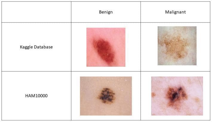 This comparison chart displays four dermoscopic images of skin lesions, organized into a 2x2 grid to illustrate the visual differences between benign and malignant tumors across two different medical datasets: Kaggle and HAM10000. In the Kaggle dataset row, the benign lesion shows a relatively symmetric, dark red-brown oval with regular borders, while the malignant lesion displays an irregular, pale tan-to-brown appearance with asymmetric pigmentation and peripheral white circular structures. In the HAM10000 row, the benign lesion is characterized by a well-demarcated, dark brown pigmentation with a fairly uniform texture. The corresponding malignant lesion exhibits hallmark features of melanoma, including asymmetry, irregular borders, and a variegated color pattern featuring a dark central focus with radial streaming or 'star-like' extensions. The image serves as an educational tool for clinical dermatology, highlighting key diagnostic morphological features such as pigment distribution, border regularity, and architectural patterns used in the differential diagnosis of skin cancer.