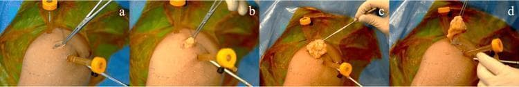 A sequence of four intraoperative clinical photographs (a-d) demonstrating the surgical resection and extraction of a subdeltoid lipoma from a human shoulder. The surgical field is prepared with blue and yellow sterile drapes, and several arthroscopic portals with orange caps are visible. (a) An Allis forceps is inserted through an extended 2.5 cm superolateral portal to grasp the underlying mass. (b-c) The yellowish, lobulated, and well-circumscribed lipomatous mass is progressively delivered through the incision. The texture of the lesion is characteristic of mature adipose tissue, showing a soft, fatty, and nodular appearance. (d) Final delivery of the specimen using the Allis forceps. The procedure illustrates the transition from arthroscopic identification to open extraction via a minimally invasive portal extension. This educational sequence highlights surgical technique for deep soft-tissue tumor removal, focusing on instrument use and tissue morphology within the orthopedic surgical domain.