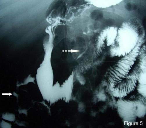 This diagnostic fluoroscopic image captures a small bowel barium follow-through study, a common radiographic procedure for evaluating the gastrointestinal tract. The image highlights significant pathology through the abnormal distribution of radiopaque barium contrast. A continuous white arrow identifies a coloduodenal fistula, showing a direct connection between the ascending colon and the second portion of the duodenum. A dotted white arrow points to multiple fistulous tracts originating from the jejunum and extending into the lesser sac (omental bursa). The small bowel loops demonstrate characteristic valvulae conniventes, while the barium-filled fistulae appear as narrow, linear channels of contrast escaping the normal intestinal lumen. This study is clinically significant for diagnosing penetrating Crohn's disease or other inflammatory/infectious processes that lead to enteric fistula formation. The image provides critical visual evidence for surgical planning and disease staging by mapping complex anatomical communications between adjacent organs and peritoneal spaces.