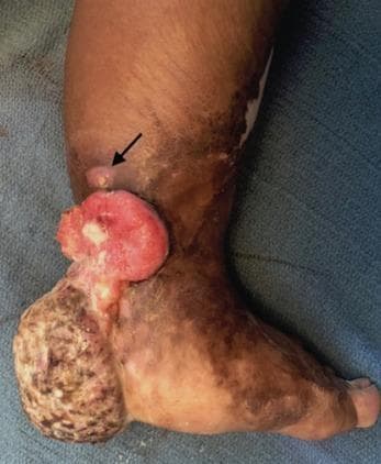 Clinical photograph of the medial and posterior aspects of a human foot showing a large, exophytic, fungating mass and extensive scarring. The mass is localized to the posterior heel and Achilles tendon region, measuring approximately 6x10x12cm. It exhibits a heterogeneous appearance with a reddish, fleshy, and friable proximal border, while the more distal portion on the plantar heel shows a rough, cauliflower-like texture with areas of yellow-brown discoloration and suspected necrosis. An arrow points to a smaller, elevated satellite lesion superior to the main mass. The surrounding integument of the foot and distal leg shows significant chronic scarring, dyspigmentation, and texture changes consistent with prior burn injuries. This clinical presentation is highly suggestive of a Marjolin ulcer, a squamous cell carcinoma arising from a chronic burn scar. The educational focus is on identifying malignant transformation in chronic wounds and understanding the visual morphology of aggressive skin malignancies.