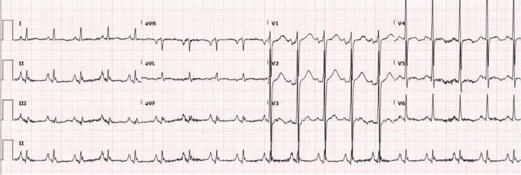 A standard 12-lead electrocardiogram (ECG) displayed in a traditional 3x4 grid layout with a rhythm strip (Lead II) at the bottom. The tracing exhibits sinus tachycardia, characterized by a rapid heart rate with narrow QRS complexes and visible P-waves preceding each complex. Key morphological findings include prominent Q-waves in the inferior leads (II, III, and aVF), consistent with an old inferior wall myocardial infarction. There are signs of left ventricular hypertrophy (LVH), indicated by high QRS voltage in the precordial leads (specifically tall R-waves in V4-V6 and deep S-waves in V1-V3). The QTc interval is prolonged, measured at 484 ms. The P-waves in the inferior leads show increased amplitude, suggesting right atrial enlargement. These findings provide critical clinical context for evaluating cardiovascular pathology, including prior ischemia, structural chamber remodeling, and repolarization abnormalities.