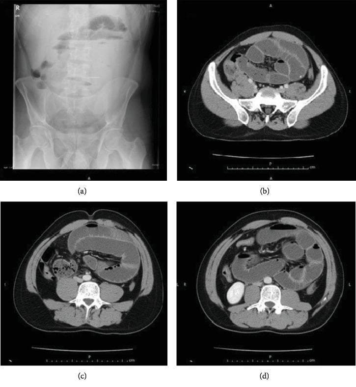 This composite of diagnostic images illustrates findings characteristic of a mechanical intestinal obstruction. Panel (a) is an upright plain abdominal X-ray (radiograph) demonstrating multiple dilated loops of small bowel with prominent air-fluid levels, visible as sharp horizontal interfaces between radiolucent gas and radiopaque fluid. Panels (b), (c), and (d) are axial (transverse) slices of a contrast-enhanced abdominal computerized tomography (CT) scan. These images show significantly dilated loops of the small intestine with associated wall thickening. The CT images reveal the clustering of the small bowel loops and help delineate the transition zone or specific location of the pathology. Together, these imaging modalities provide evidence for small bowel ileus, often caused by conditions such as abdominal cocoon syndrome (ACS), adhesions, or internal herniation. The visual data is intended for medical education regarding the radiological diagnosis of acute mechanical intestinal obstruction and the assessment of bowel wall edema and luminal dilatation.