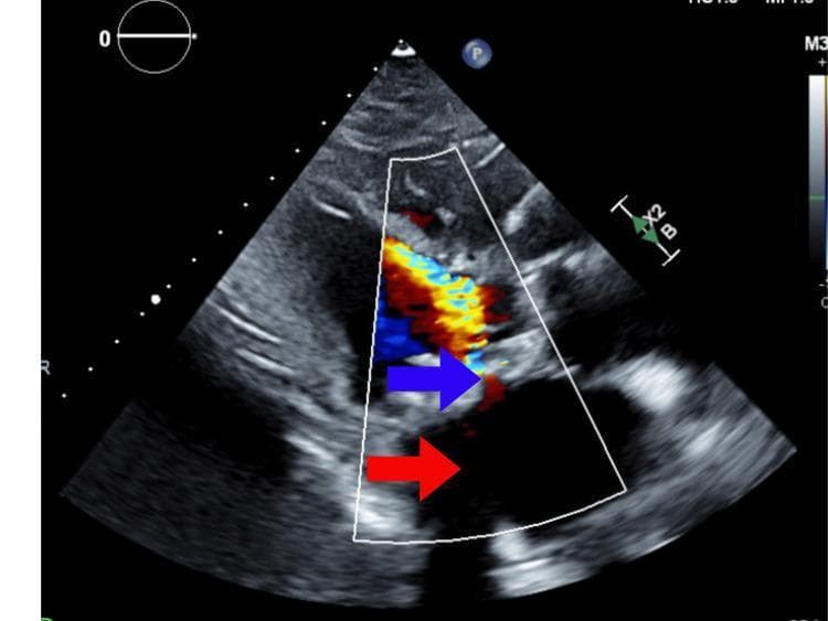 This diagnostic image is a transthoracic echocardiogram utilizing Color Flow Doppler to evaluate cardiac hemodynamics. The image primarily demonstrates severe mitral valve stenosis and its associated secondary anatomical changes. A red arrow identifies a severely dilated left atrium, indicating chronic pressure and volume overload. A blue arrow points to the stenotic mitral valve orifice. The Color Doppler signal illustrates the characteristic flow disturbances of stenosis: proximal to the mitral valve, there is a large area of red-coded flow representing blood moving toward the transducer; as blood passes through the narrowed valve, it transitions into a high-velocity, turbulent jet distal to the valve, characterized by a mosaic of blue, yellow, and green colors indicating aliasing and flow acceleration. This visual confirms the restricted valvular opening and significant obstructive gradient across the bioprosthetic mitral valve, consistent with a clinical diagnosis of prosthetic valve stenosis in a patient presenting with cardiogenic shock.