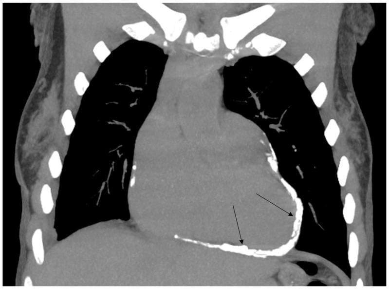 This diagnostic image is a coronal Computed Tomography (CT) scan of the thorax demonstrating a classic presentation of constrictive pericarditis. The primary pathology is characterized by extensive, circumferential, high-density calcification and thickening of the pericardium, indicated by black arrows. The pericardium appears as a bright, hyperdense rim encasing the heart, particularly along the inferior and lateral borders of the cardiac silhouette. This dense calcification is a hallmark sign of chronic pericardial inflammation, often resulting from prior radiotherapy or infection. Within the thoracic cavity, the heart occupies a central position with an altered, somewhat tubular shape due to the rigid pericardial shell. The bilateral lung fields appear hypodense (dark), contrasting with the skeletal structures of the rib cage and vertebrae. This visual material is highly relevant for cardiology and radiology education, illustrating the structural manifestations of radiation-induced cardiac disease and the pathophysiology of diastolic heart failure caused by pericardial constriction.