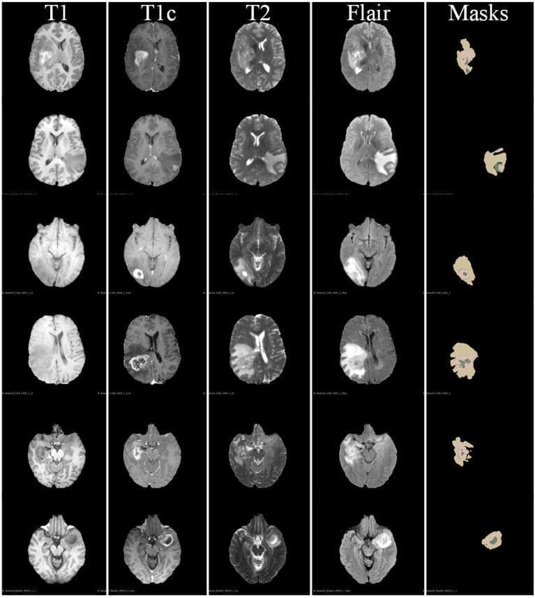 A multi-modal comparison chart displaying axial brain MRI slices from the BraTS 2018 dataset, focused on neuro-oncological diagnostic imaging. The image is organized into a grid with six rows of distinct axial slices and five columns representing different MRI sequences and segmentation masks. The sequences include T1-weighted (T1), contrast-enhanced T1 (T1c), T2-weighted (T2), and Fluid Attenuated Inversion Recovery (FLAIR). The final column, 'Masks', displays color-coded segmentation results. The visual demonstrates the varying presentation of brain tumors: T1 shows hypointense regions; T1c highlights enhancing tumor cores; T2 and FLAIR exhibit hyperintense signals that delineate peritumoral edema and the whole tumor (WT) extent. The segmentation masks demonstrate the automated classification of tumor sub-regions, including the enhancing tumor, tumor core (TC), and edema. This comparison illustrates how different modalities contribute to identifying tumor margins and internal morphology for clinical diagnosis and radiotherapy planning in neuroradiology.