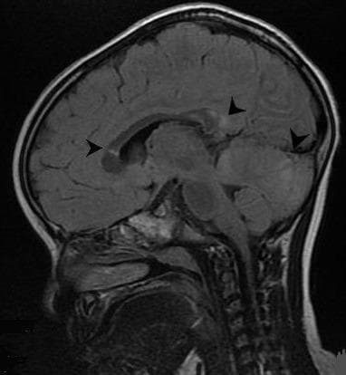 This diagnostic image is a sagittal T2-weighted Fluid-Attenuated Inversion Recovery (FLAIR) MRI scan of a pediatric patient's brain. The image highlights several hyperintense (bright) focal lesions, indicated by black arrowheads, which are characteristic of Diffuse Axonal Injury (DAI). These signal changes are located within critical neuroanatomical structures susceptible to shear-strain forces, including the splenium of the corpus callosum, the basal ganglia, and the cerebellar hemisphere. Morphologically, the lesions appear as small, rounded areas of high signal intensity, often referred to as 'axonal bulbs' or 'retraction balls' when viewed in the subacute phase of traumatic brain injury. The presence of these lesions in the corpus callosum and cerebellum is clinically significant as it correlates with secondary neurological manifestations such as tremor and dystonia following head trauma. This educational visual demonstrates the sensitivity of MRI over CT in detecting non-hemorrhagic DAI and provides a clear example of typical lesion distribution in traumatic axonal pathology.