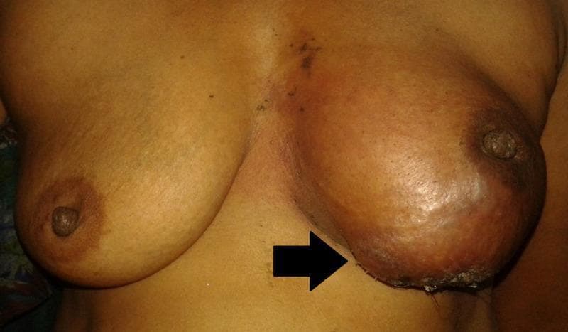 This clinical photograph shows a comparative frontal view of the female chest, highlighting significant pathology in the left breast. The left breast is markedly enlarged and asymmetric compared to the right. The overlying skin of the left breast demonstrates diffuse erythema, peau d'orange-like dimpling, and textural changes indicative of underlying malignancy. The nipple of the left breast is noticeably retracted and inverted. A black arrow points to the inferior aspect of the left breast where there is evidence of skin ulceration and crusting. These clinical findings, including the inflammatory appearance and structural distortion, are highly suggestive of advanced breast cancer, specifically metaplastic carcinoma or inflammatory breast cancer. This image is used in medical education to demonstrate classic physical examination signs of locally advanced breast malignancy, such as nipple retraction, skin dimpling, and inflammatory changes.