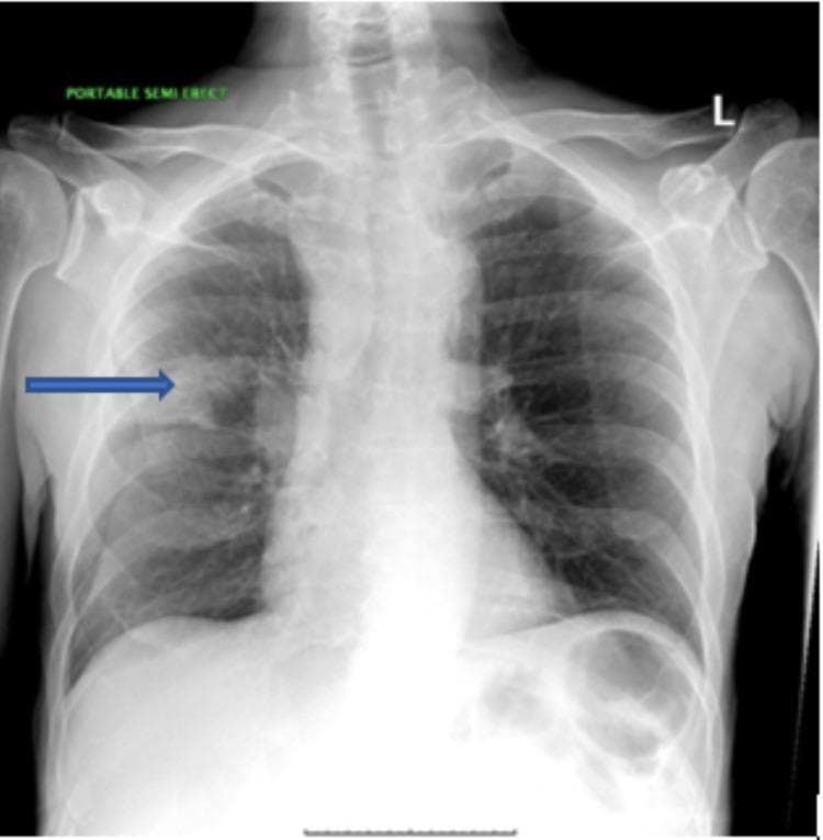 This diagnostic image is a posterior-anterior (PA) chest radiograph demonstrating a focal pulmonary abnormality. A prominent 3 cm radiopaque mass is visible in the right upper lobe, positioned superior to the minor fissure (indicated by a blue horizontal arrow). The mass exhibits irregular borders with an infiltrative appearance extending medially toward the right hilum. The right hilum and right paratracheal soft tissues appear prominent, suggesting possible lymphadenopathy. In contrast, the left lung field is clear. Anatomical landmarks including the trachea, mediastinal contours, and hemidiaphragms are visible, with the right hemidiaphragm normally positioned slightly higher than the left. The cardiac silhouette and skeletal structures of the thorax, including the clavicles and ribs, appear unremarkable. This clinical photograph is highly relevant for medical education regarding the radiological presentation of primary bronchogenic carcinoma, specifically pulmonary adenocarcinoma. It illustrates key diagnostic findings such as lung masses, hilar prominence, and the importance of localized lobe anatomy in chest imaging interpretation.