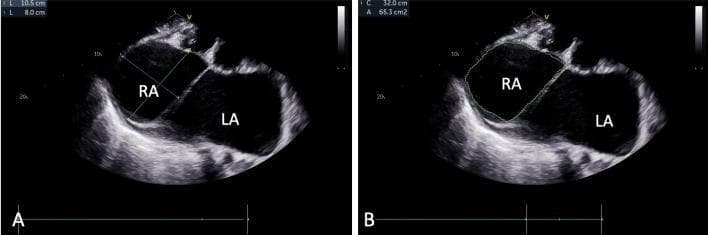 Two-dimensional transthoracic echocardiography images illustrating massive biatrial enlargement, with a primary focus on a giant right atrium (RA). The images show a side-by-side comparison of different measurement modalities. Panel A demonstrates linear measurements of the RA, showing dimensions of 10.5 cm by 8.0 cm. Panel B displays the planimetric measurement of the same chamber, revealing a massive right atrial area of 65.3 cm² and a circumference of 32.0 cm. The left atrium (LA) is also prominently enlarged and labeled. These findings are clinically significant in the context of chronic valvular disease, such as rheumatic heart disease with severe mitral and tricuspid involvement, leading to extreme chamber remodeling. The echocardiogram serves as an educational tool for identifying advanced stages of valvular pathology and severe atrial volume overload.