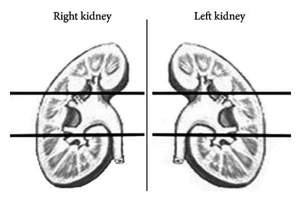 This anatomical diagram illustrates a coronal cross-section of both the right and left kidneys, designed to demonstrate the standardized protocol for evaluating renal function using DMSA scintigraphy. The image shows the internal macrostructure of each kidney, including the renal cortex, medulla with renal pyramids, and the renal pelvis leading to the proximal ureters. A vertical line separates the two organs. Crucially, the diagram features two horizontal black lines intersecting both kidneys to delineate three distinct functional zones or 'paired poles': the upper pole, the middle pole, and the lower pole. This schematic representation is used clinically to facilitate the comparative analysis of regional tracer uptake, allowing for a quantitative assessment of differential renal function across specific anatomical segments. The visual format is tailored for educational purposes in nuclear medicine and urology, particularly for understanding post-surgical evaluations like those following percutaneous nephrolithotomy (PCNL).