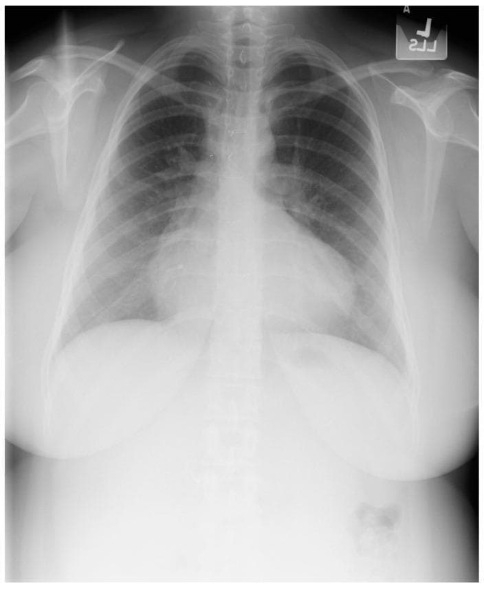 This diagnostic posteroanterior (PA) chest X-ray demonstrates the characteristic findings of Tetralogy of Fallot in a 21-year-old female patient. The image shows a well-centered view with adequate inspiratory effort. The primary finding is an increased cardiothoracic ratio with a distinctive 'boot-shaped' heart, also known as 'coeur en sabot.' This morphology is characterized by an upturned cardiac apex, resulting from significant right ventricular hypertrophy, and a concave pulmonary artery segment. The right heart border is notably prominent, indicating right atrial enlargement. Despite the history of surgical repair (including VSD closure and RV outflow tract reconstruction), these structural changes remain visible. The pulmonary vasculature appears normal, and the lung fields are clear without evidence of opacities, focal lesions, or pleural effusions. Sternal wires and surgical markers from prior cardiac procedures may be visible in the midline. The image serves as a classic educational example of chronic cardiac remodeling in congenital heart disease.