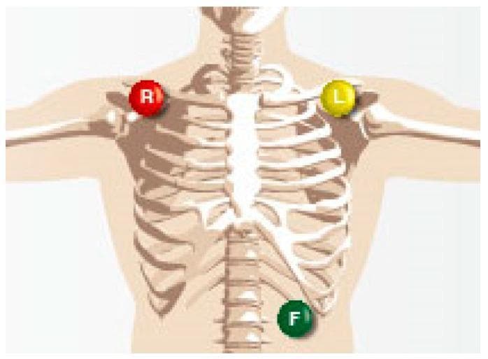 This anatomical diagram illustrates a standard 3-lead electrocardiogram (ECG) electrode placement configuration on a human torso. The visual focuses on the skeletal and surface anatomy to define precise lead locations. A red electrode, labeled 'R', is positioned on the right infraclavicular fossa near the right shoulder. A yellow electrode, labeled 'L', is placed in a mirroring position on the left infraclavicular fossa. A third green electrode, labeled 'F', is situated on the lower left abdomen, typically above the left iliac crest or inferior to the costal margin. This configuration represents the three primary limb leads (Leads I, II, and III) based on Einthoven's Triangle, used for monitoring cardiac electrical activity and heartbeat signals. The use of color-coding and alpha-labeling (Right, Left, Foot) serves as an educational guide for medical students and clinicians to ensure proper lead attachment in diagnostic and monitoring settings.