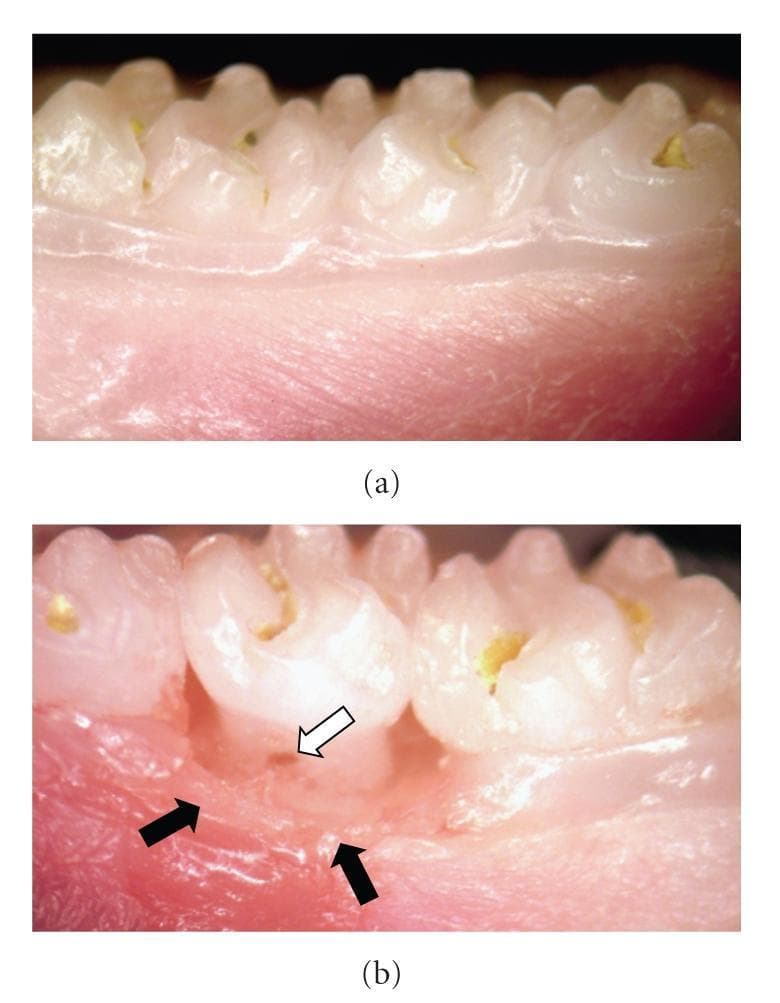 This intraoral clinical photograph, taken at 15X magnification, provides a side-by-side comparison of healthy and periodontal-diseased tissue in a dental model. Panel (a) illustrates healthy gingiva, characterized by a smooth, light pink appearance, firm texture, and intact structural integrity around the teeth with no signs of inflammation. In contrast, panel (b) demonstrates the macroscopic manifestations of progressive periodontal disease. Key diagnostic features highlighted by black arrows include significant gingival inflammation, marked by intense redness (erythema), swelling (edema), and the destruction of normal gingivomucosal structures. A white arrow specifically points to a furcation lesion, indicating advanced tissue and bone loss between the roots of the affected molar. This image serves as a visual educational tool to identify the clinical differences between healthy periodontal support and the inflammatory-destructive processes characteristic of periodontitis.