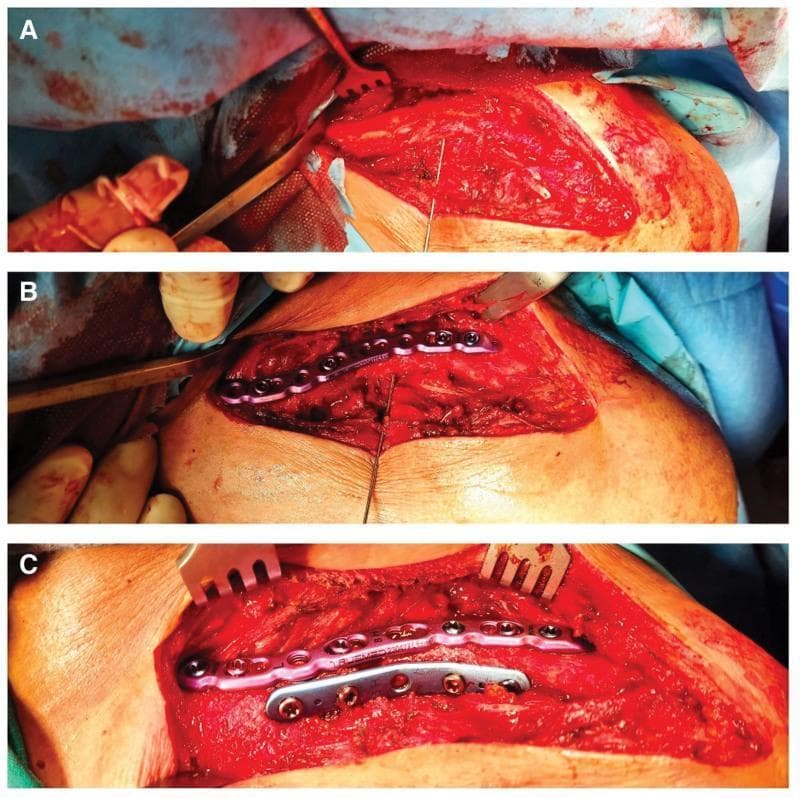 This sequence of three clinical intraoperative photographs (A, B, C) documents the progression of an open reduction and internal fixation (ORIF) of a midshaft clavicle fracture using a dual-plating technique.