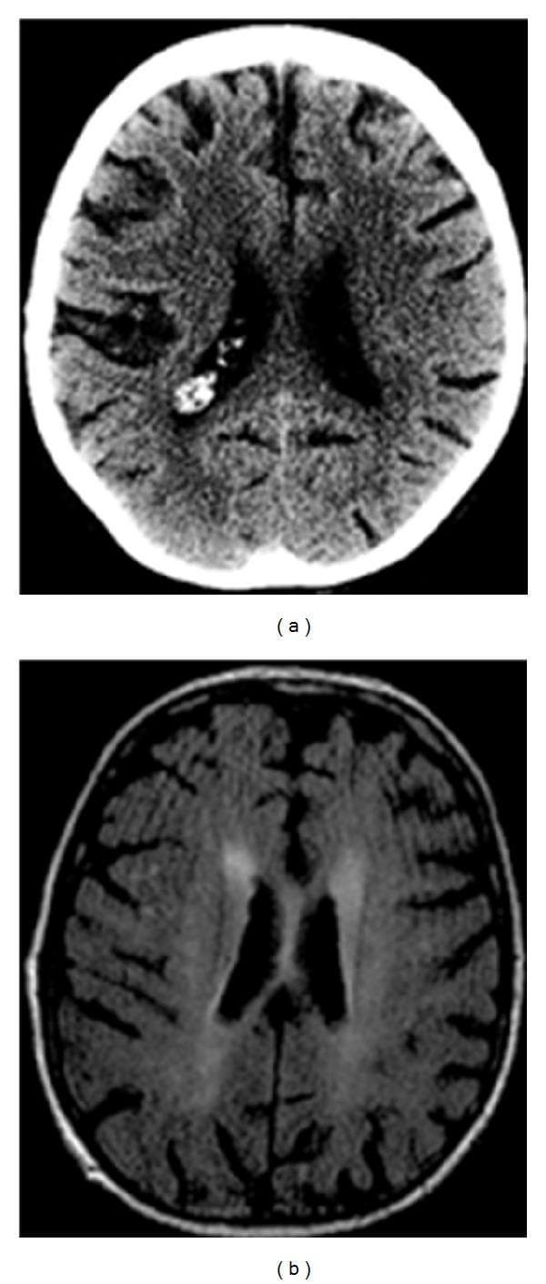 This composite figure presents two axial cross-sections of the brain for clinical diagnosis. Image (a) is an unenhanced Computed Tomography (CT) scan at the level of the lateral ventricles, showing a localized area of hyperattenuation within the left central sulcus, consistent with a focal subarachnoid hemorrhage. Notably, there is an absence of significant mass effect or midline shift. Image (b) is a Magnetic Resonance (MR) FLAIR sequence showing the same anatomical level. It reveals bilateral, ill-defined areas of hyperintensity in the periventricular and deep white matter, representing non-specific leukoaraiosis or chronic microvascular changes. These combined findings—isolated sulcal hemorrhage and white matter disease—are key radiologic markers in the assessment of Cerebral Amyloid Angiopathy (CAA). The target audience includes radiology residents and neurology specialists focusing on stroke and neurodegenerative pathologies.