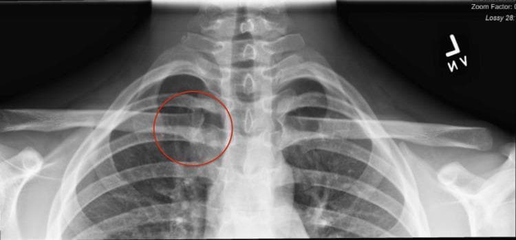 This diagnostic image is an anterior-posterior (AP) X-ray radiograph of the upper thoracic cage, focusing on the pectoral girdle and midline skeletal structures. Visible anatomy includes the cervical and upper thoracic vertebrae, bilateral clavicles, scapulae, and the superior ribs. A red circle highlights the right sternoclavicular joint (SCJ), where the medial end of the right clavicle articulates with the manubrium of the sternum. While the overall bony alignment appears grossly normal in this static view, the highlighted area is marked for clinical evaluation of potential joint instability, such as subluxation or asymmetric widening of the joint space. The radiograph serves as a primary screening tool for orthopedic assessment of the sternoclavicular region in the context of traumatic injury or ligamentous laxity. The lung apices and trachea are also partially visible, providing anatomical context for the thoracic inlet.