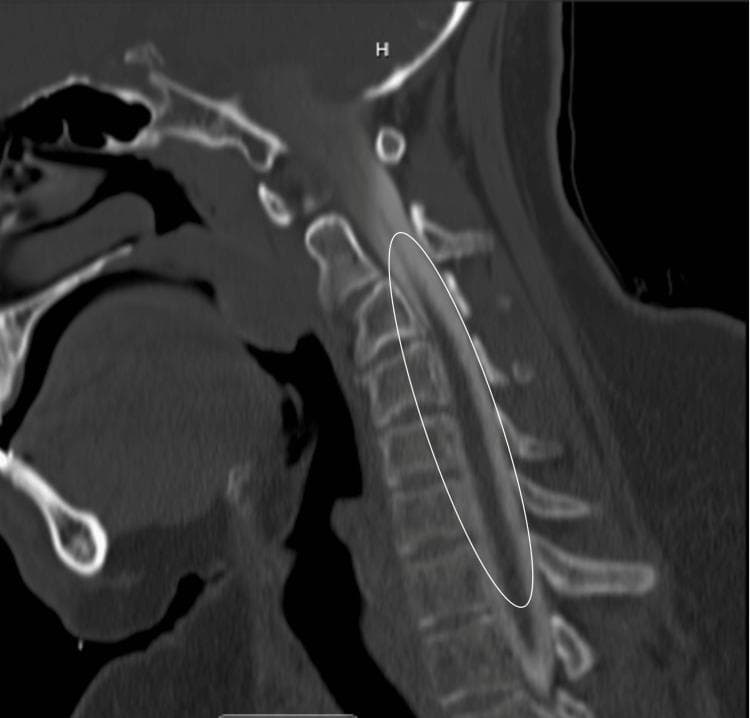 This diagnostic image is a CT cervical myelogram in the sagittal view, demonstrating the anatomy and pathology of the cervical spine from C1 through the upper thoracic vertebrae. The thecal sac is opacified with hyperdense contrast material (appearing bright white), allowing for clear visualization of the spinal cord (appearing relatively hypodense) and the surrounding subarachnoid space. In the highlighted area from C3 to C7, multiple mild disc bulges are visible as focal indentations on the anterior aspect of the contrast-filled thecal sac. The vertebral bodies maintain their rectangular morphology, and the alignment of the anterior and posterior longitudinal ligaments appears intact. The spinal cord itself shows no significant displacement or focal signal changes in this view, and the neural foramina are not significantly stenosed. This imaging modality is essential for evaluating disc-related compression, canal stenosis, and the relationship between the intervertebral discs and the central nervous system structures in patients with neck pain or radiculopathy.