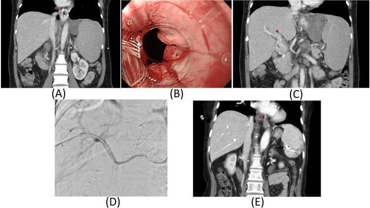 A composite medical image illustrating the diagnosis and treatment of portal hypertension. (A) Coronal CT scan shows splenomegaly and prominent esophageal varices in the absence of liver cirrhosis. (B) Endoscopic view (EGD) of the gastroesophageal junction reveals dilated, tortuous esophageal varices with a 'white nipple sign,' indicating a recent hemorrhage and fibrin clot formation. (C) Coronal CT scan highlights portal vein thrombosis, characterized by a filling defect in the portal venous system, which serves as the etiology for pre-hepatic portal hypertension. (D) Intraoperative fluoroscopic image demonstrates the placement of a portal vein stent via an interventional radiology approach. (E) Follow-up coronal CT scan displays the successful resolution of previously noted esophageal varices and restoration of vascular flow following the stenting procedure. This series provides an educational overview of non-cirrhotic portal hypertension management, from diagnostic imaging and endoscopic stigmata of bleeding to therapeutic intervention and radiological follow-up.