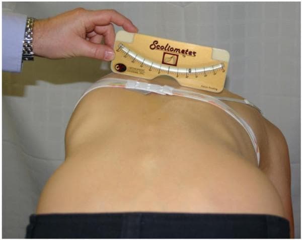 A clinical photograph demonstrating a procedural assessment for scoliosis using the Adams forward bend test. The patient is positioned in forward flexion, which highlights a prominent right-sided rib hump, indicative of thoracic vertebral rotation and spinal convexity. An examiner is shown holding a Scoliometer (a specialized inclinometer) across the patient's mid-thoracic spine to quantify the Angle of Trunk Rotation (ATR). The device features a curved scale and a ball bearing level to provide a numerical degree of asymmetry. This clinical procedure is a standard screening and monitoring tool used in orthopedics and physical therapy to evaluate the severity and progression of adolescent idiopathic scoliosis and other structural spinal deformities. The image clearly illustrates the anatomical relationship between spinal curvature and visible thoracic cage distortion.