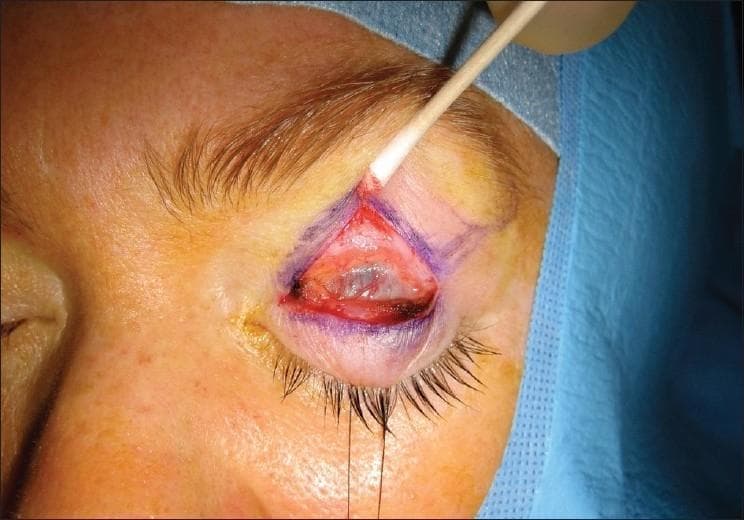 This clinical photograph captures an intraoperative view of an external levator approach for congenital ptosis repair on a patient's upper eyelid. The surgical field demonstrates a horizontal eyelid crease incision, outlined by purple surgical marker ink. The incision has been deepened to expose the underlying anatomical structures, specifically the levator aponeurosis and preseptal tissues. A cotton-tipped applicator is utilized for gentle retraction and hemostasis within the triangular-shaped surgical pocket. Traction sutures are visible, extending from the eyelid margin to facilitate positioning and exposure. The surrounding periocular skin shows mild erythema consistent with surgical trauma, alongside natural signs of aging and freckling. This image serves as an educational resource for ophthalmology and oculoplastic surgery, illustrating the anterior surgical approach to the levator complex for the correction of blepharoptosis.