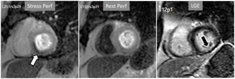 This Comparison Chart displays three short-axis Cardiac Magnetic Resonance (CMR) images illustrating stress/rest perfusion and Late Gadolinium Enhancement (LGE) in a patient with chronic myocardial infarction. The first panel (Stress Perf) shows a subendocardial perfusion defect in the inferior wall of the left ventricle, indicated by a white arrow, characterized by a dark region of low signal intensity. The second panel (Rest Perf) demonstrates the resolution of this defect at rest, suggesting inducible ischemia. The third panel (LGE) shows a localized area of hyperintensity in the inferior subendocardium (black arrow), representing a myocardial scar from a previous infarct. Notably, the stress perfusion defect is larger than the LGE scar, indicating a peri-infarction zone of reversible ischemia. This diagnostic imaging sequence is used in cardiology to differentiate between fixed myocardial necrosis and viable but ischemic tissue, which is critical for guiding revascularization decisions in ischemic cardiomyopathy.