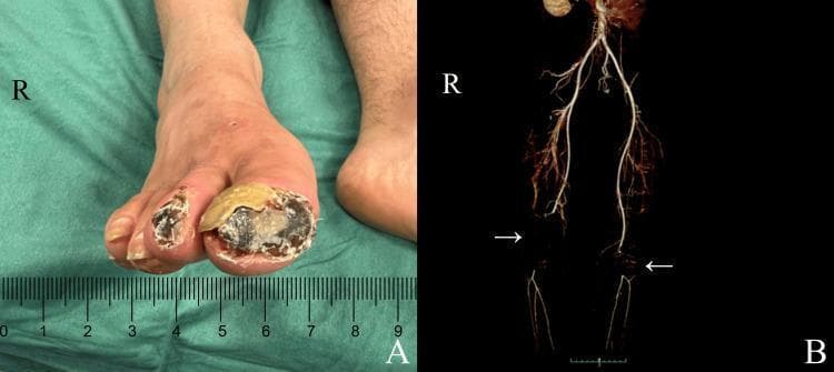 This composite educational image illustrates the clinical and radiological findings of Thromboangiitis Obliterans (Buerger's disease). Panel A is a clinical photograph of a right foot showing advanced ischemic ulcerated lesions and dry gangrene affecting the distal first (hallux) and second toes. The hallux exhibits a large, necrotic black center with an overlying yellowish-tan hyperkeratotic rim, while the second toe shows smaller, deep necrotic lesions. Panel B presents a posterior view of a 3D-reconstructed contrast-enhanced CT arteriogram of the lower extremities. White arrows highlight significant arterial obstructions: occlusion of the right superficial femoral artery extending to the popliteal artery, and occlusion of the left popliteal artery. There is a notable absence of contrast enhancement in the distal runoff vessels, indicating severe limb ischemia. The image demonstrates the correlation between proximal arterial occlusive disease and distal tissue necrosis, emphasizing the diagnostic importance of vascular imaging in peripheral arterial disease management.
