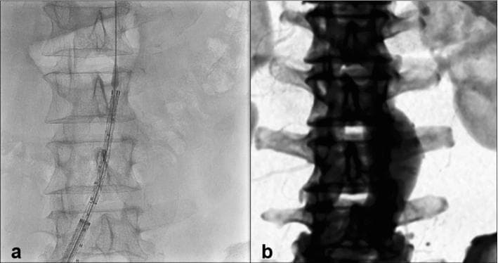 A side-by-side comparison of two diagnostic imaging modalities used during endovascular aneurysm repair (EVAR) for an infrarenal abdominal aortic aneurysm. Image (a) is an intraoperative fluoroscopic frame from a digital subtraction angiography (DSA) procedure. It shows a grayscale anteroposterior view of the lumbar vertebral column with a radiopaque catheter and pigtail markers visible. The pigtail markers are spaced at 10mm intervals for calibration. Image (b) shows a preoperative computed tomography angiography (CTA) scan converted into a digital X-ray projection (DRR) through automated segmentation. The vertebral bodies in the DRR appear with higher contrast and more sharply defined cortical edges compared to the live fluoroscopy. The comparison illustrates the process of automated image fusion, where the skeletal landmarks from the preoperative CTA are registered and superimposed onto the real-time fluoroscopic field to improve vascular alignment and surgical precision during stent-graft deployment.