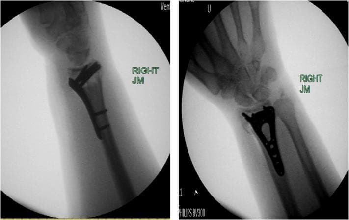 This diagnostic image consists of two intraoperative fluoroscopic films of the right wrist, demonstrating the internal fixation of a distal radius fracture. The left panel shows a lateral view where a radiopaque volar locking plate is positioned along the anterior (volar) cortex of the distal radius, spanning from the radial diaphysis to the metaphysis. The plate's contour follows the anatomical curve of the radial neck. The right panel shows an anteroposterior (AP) view, highlighting the triangular, anatomically shaped distal portion of the plate. Multiple screw holes and securing screws are visible, providing stable fixation across the fracture site. The radiocarpal joint is visualized, showing the alignment between the distal radius and the proximal carpal row (scaphoid and lunate). These images illustrate standard orthopedic surgical management for comminuted distal radius fractures using a locking plate system to maintain reduction and radial height.