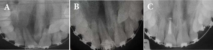 This composite of three occlusal radiographs (A, B, and C) illustrates the progression and nonsurgical management of a periapical lesion in the maxillary anterior region. Image A shows a large, well-defined periapical radiolucency surrounding the apex of the maxillary right central incisor, consistent with a radicular cyst or periapical granuloma; the tooth exhibits a wide pulp canal and immature apex. Image B demonstrates the same region after 6 months of intracanal calcium hydroxide treatment, showing initial osseous regeneration and a reduction in the size of the radiolucent area. Image C shows the 20-month follow-up, where the root canal has been filled with a radiopaque medicament (calcium hydroxide), and there is significant bone healing and resolution of the periapical pathology. The patient is also seen with fixed orthodontic appliances (brackets and archwires) present throughout the treatment sequence. This comparison highlights the efficacy of long-term calcium hydroxide therapy in promoting periapical healing and apexification.