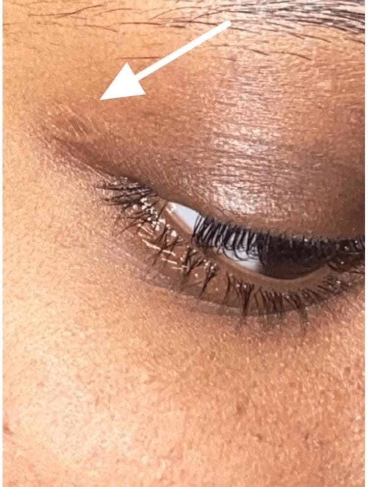 This clinical photograph shows a close-up, lateral view of a patient's right eye and upper eyelid following the surgical excision of a molluscum contagiosum (MC) lesion. The focus is on the eyelid's surface, which demonstrates a successful post-operative result. A white arrow points to the lateral aspect of the upper eyelid where the excision was performed, highlighting a small, slightly raised area near the lash line that is nearly indistinguishable from the surrounding skin texture. The skin exhibits a normal tone without significant hyperpigmentation, erythema, or visible scarring. The eyelid margin is well-aligned and preserved, showing no evidence of ectropion, entropion, or mechanical distortion. The eyelashes are intact, and the conjunctiva appears healthy. This image is used to illustrate the satisfactory cosmetic and functional outcomes that can be achieved through simple unroofing and curettage for pedunculated eyelid lesions, confirming the absence of residual pathology or surgical complications in a common dermatological viral infection case.