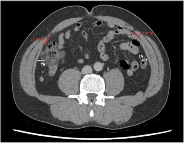 This diagnostic image is an axial computed tomography (CT) scan of the human abdomen at the level of the umbilicus. The scan focuses on the anatomy of the anterior and lateral abdominal wall. The three distinct muscle layers of the lateral abdominal wall are visible: the external oblique, internal oblique, and the innermost layer, the transversus abdominis (labeled 'TA'). Red measurement lines indicate the distance between the medial edge of the transversus abdominis muscle and the linea semilunaris, with values recorded as 11.4 mm on the patient's right and 10.4 mm on the left. The rectus abdominis muscles are visible medially, separated by the linea alba. The vertebral body and psoas muscles are seen posteriorly, while loops of bowel and mesenteric fat occupy the intra-abdominal space. This image demonstrates the use of radiological imaging to quantify anatomical variations in abdominal wall musculature, which is clinically significant for planning surgical procedures such as posterior component separation or transversus abdominis release (TAR).