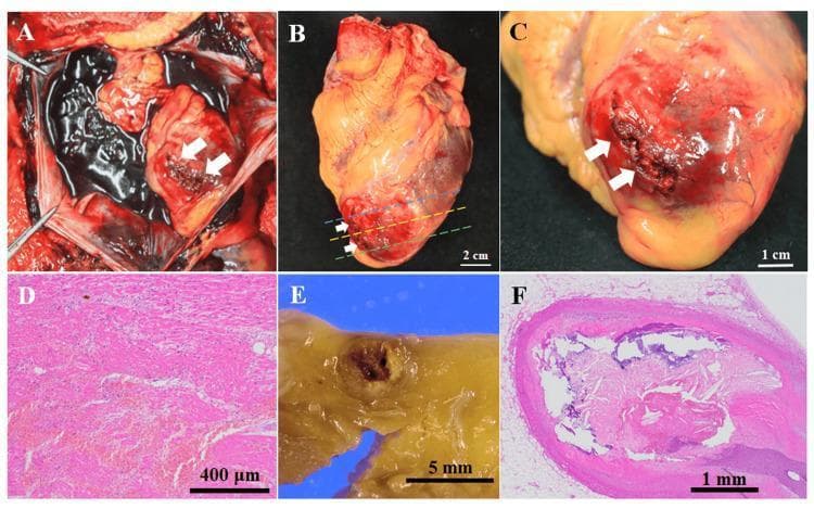This composite image illustrates the macroscopic and microscopic pathology of a fatal myocardial infarction. Panel A shows an in situ autopsy view of the pericardial cavity filled with dark, clotted blood (hemopericardium), secondary to a left ventricular rupture (white arrows). Panels B and C provide gross views of the excised heart, highlighting a transmural rupture at the apex of the left ventricle with surrounding hemorrhage and necrotic tissue discoloration. Panel D is a low-power histopathological image (H&E stain) of the myocardium near the rupture, showing coagulative necrosis, hemorrhage, and early fibroblast proliferation. Panel E shows a macroscopic cross-section of the left anterior descending (LAD) coronary artery with near-total luminal occlusion. Panel F presents a corresponding H&E-stained micrographic cross-section of the LAD, demonstrating a complex atherosclerotic plaque with rupture, significant luminal narrowing, and areas of calcification. These findings collectively demonstrate a clinical sequence of coronary occlusion leading to transmural infarction and subsequent lethal cardiac tamponade.