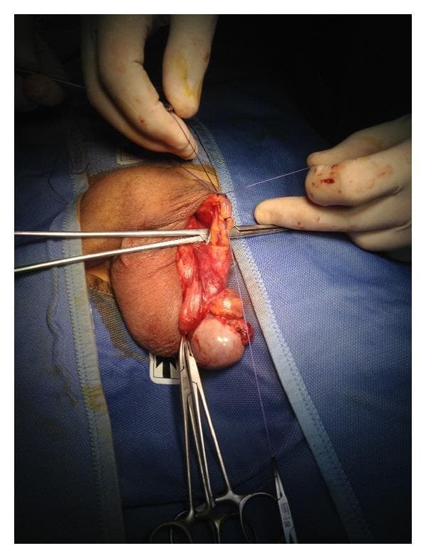 This clinical photograph shows an intraoperative view of a male surgical procedure, specifically the ligation of the anterior spermatic venous plexus for the treatment of varicocele. The surgical field is established through a scrotal approach, with the patient draped in a sterile blue cloth. The exposed anatomical structures include the left testis, tunica vaginalis, and the spermatic cord. Multiple surgical instruments are in use, including Farabeuf retractors and hemostatic forceps, which are being utilized to retract tissue and isolate vascular structures. A surgeon's hands are visible, demonstrating the application of a blue, absorbable suture (likely 2.0 Vicryl) to perform an en bloc ligation of the venous plexus near the external inguinal ring. The educational focus of this image is to illustrate the surgical anatomy of the male reproductive system and the technique of proximal spermatic cord dissection to preserve testicular vascularization during varicocelectomy or hydrocele repair.