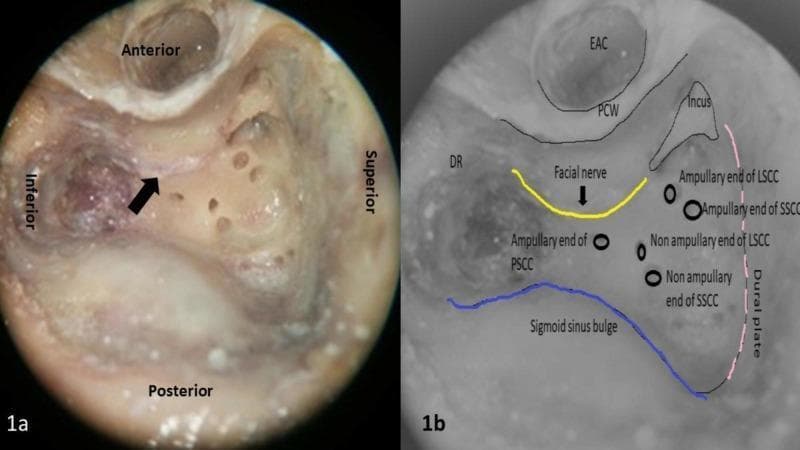 This medical visual consists of two parts: a clinical photograph of a surgical dissection (1a) and a corresponding anatomical diagram (1b) focusing on the surgical anatomy of the left temporal bone. Image 1a shows a cortical mastoidectomy and labyrinthectomy, highlighting the facial nerve (indicated by a black arrow) situated in the posterior canal wall. The orientation labels show the anterior, posterior, superior, and inferior margins of the operative field. Image 1b is an illustrative overlay depicting key landmarks for otologic surgery, including the facial nerve (yellow line), the sigmoid sinus bulge (blue line), and the dural or tegmen plate (pink dotted line). The diagram further identifies the external auditory canal (EAC), posterior canal wall (PCW), and the digastric ridge (DR). Specific surgical landmarks for the vestibular system are noted, including the ampullary and non-ampullary ends of the lateral (LSCC), posterior (PSCC), and superior (SSCC) semicircular canals, as well as the position of the incus. This content is intended for intermediate to advanced otorhinolaryngology education regarding mastoid surgery and facial nerve identification.