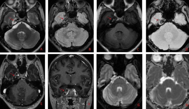 A multi-paneled figure (A-H) displaying post-operative MRI sequences of the brain in axial and coronal planes, demonstrating a residual extra-axial lesion in the right Meckel’s cave. Panel A (T2), B (FLAIR), and D (Gradient/GRE) show the lesion as hypointense relative to gray matter. Panel C (T1-weighted) reveals intrinsic hyperintensity, suggesting high protein, melanin, or paramagnetic content. Axial (E) and coronal (F) post-gadolinium sequences demonstrate minimal contrast enhancement. Diffusion-weighted imaging (G) and corresponding ADC map (H) show no restricted diffusion. Anatomically, the lesion (red arrows) is localized to the right trigeminal cistern, abutting the cavernous segment of the internal carotid artery and the vestibulocochlear-facial (VII/VIII) nerve complex. The presentation is consistent with heavily pigmented neurovascular pathologies, such as melanotic neoplasms. This imaging serves as a clinical example for neuro-oncology and neuroradiology, emphasizing the multi-sequence signal analysis of posterior fossa and skull base lesions.