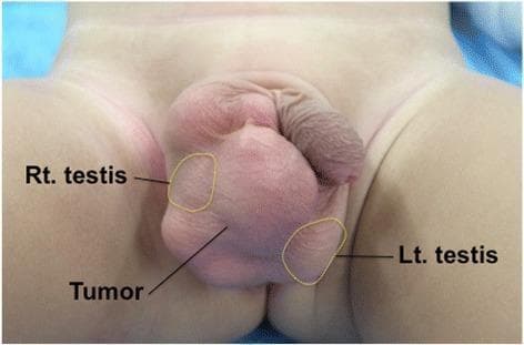 Clinical photograph of the perineal region of a pediatric patient showing significant scrotal swelling. The image features yellow-outlined areas identifying the anatomical positions of the bilateral testes, which are displaced by a large, centrally located, lobulated intrascrotal mass. The tumor is visibly larger than the testes, causing marked distension of the scrotal sac. The overlying skin appears intact and smooth without erythema or ulceration. Clinical markers indicate the tumor is independent of the testicles, localized within the right side of the scrotum. This visual demonstrates a typical presentation of an intrascrotal lipoblastoma, a rare benign mesenchymal tumor occurring in young children. The image serves to teach the differential diagnosis of pediatric scrotal masses, emphasizing the importance of identifying the relationship between the mass and normal testicular tissue during clinical examination and preoperative planning.