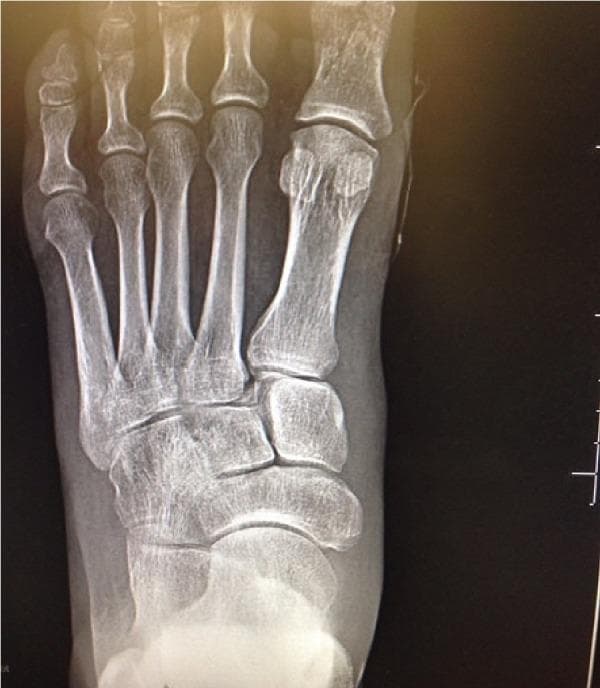 Anteroposterior (AP) radiograph of the left foot demonstrating multi-focal orthopedic injuries. Key diagnostic features include a non-displaced fracture of the proximal phalanx of the first toe (hallux) and significant pathology at the midfoot. There is a subluxation and fracture at the base of the second metatarsal, characterized by a visible 'fleck sign'—a small bony fragment located in the space between the first and second metatarsal bases. This avulsion fracture is a pathognomonic radiographic indicator of a Lisfranc ligament injury, representing a disruption of the tarsometatarsal joint complex. The image provides clinical relevance for identifying unstable midfoot injuries that may require surgical reduction and fixation. Other visible structures include the sesamoid bones beneath the first metatarsal head and the tarsal bones (cuneiforms and navicular), which serve as landmarks for assessing alignment across the Lisfranc joint line.