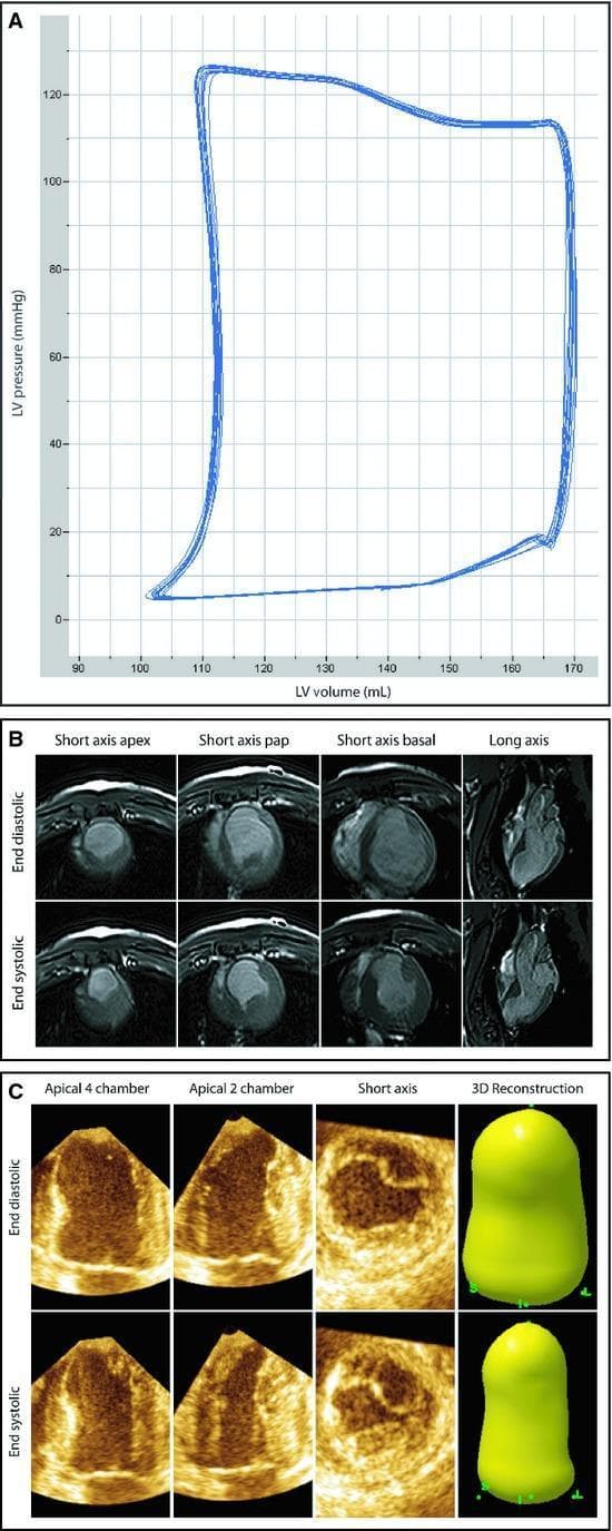 Educational composite figure demonstrating multimodal assessment of left ventricular (LV) function and volume. Panel A shows a Pressure-Volume (PV) loop graph plotting LV pressure (mmHg) against LV volume (mL), characteristic of cardiac cycle analysis. Panel B displays Cardiac Magnetic Resonance Imaging (CMRI) in a 2x4 grid comparing end-diastolic and end-systolic phases across four planes: short-axis apex, papillary muscle level, basal level, and long-axis view. These views highlight ventricular wall thickening and chamber reduction during systole. Panel C illustrates Three-Dimensional Echocardiography (3DE) including apical 4-chamber, apical 2-chamber, and short-axis views alongside a computed 3D reconstruction of the LV volume. The contrast between end-diastolic and end-systolic frames in both CMRI and 3DE allows for the calculation of stroke volume and ejection fraction. The figure serves as a comparative reference for diagnostic imaging modalities used in cardiology to quantify cardiac remodeling and performance after myocardial injury.
