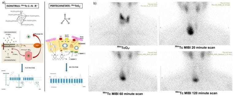 This composite educational image illustrates the pathophysiology and diagnostic imaging of thyroid nodules using dual-tracer scintigraphy. Panel (a) contains diagrams of the molecular structures of Isonitrils (99mTc-MIBI) and Pertechnetate (99mTcO4−) alongside cellular models showing their uptake mechanisms: pertechnetate via the Sodium/Iodide Symporter (NIS) and MIBI through mitochondrial trapping and P-glycoprotein (PGP) efflux. Panel (b) presents clinical nuclear medicine scans of a 42-year-old female. The 99mTcO4− scan shows a 'cold' nodule in the right thyroid lobe with significantly decreased radiotracer uptake compared to the normal left lobe. Sequential 99mTc-MIBI scans at 20, 60, and 120 minutes demonstrate 'mismatch' physiology: the nodule appears 'hot' with intense, progressive radiotracer retention and reduced efflux over time. This mismatch pattern (pertechnetate-cold/MIBI-hot with delayed retention) is a high-risk indicator for malignancy, such as Hurthle cell or papillary thyroid carcinoma, reflecting active mitochondrial metabolism and potential PGP pump dysfunction.