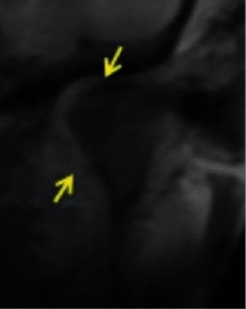 This diagnostic image demonstrates internal derangement of the temporomandibular joint (TMJ). Specifically, it illustrates a medial disc displacement where the articular disc is shifted medially relative to the medial condylar pole. Two yellow arrows indicate the specific location of the displaced disc tissue, highlighting its altered relationship with the mandibular condyle and the articular eminence of the temporal bone. The image serves as an educational example of non-anterior disc displacement patterns. In a normal configuration, the posterior band of the disc would be positioned superiorly to the condyle; however, in this case, the disc has migrated toward the medial aspect of the joint space. This imaging is critical for diagnosing temporomandibular disorders (TMD) and planning appropriate surgical or conservative interventions.