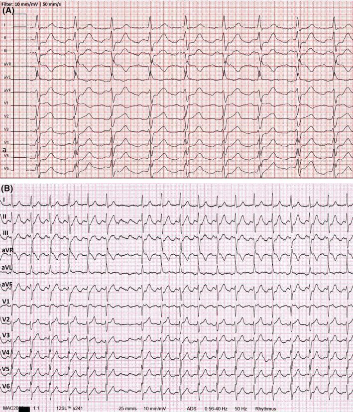 This diagnostic image displays a comparative twelve-lead electrocardiogram (ECG) split into two panels, labeled (A) and (B), showing the progression of a supraventricular arrhythmia. Panel (A) exhibits a broad-complex tachycardia with a ventricular rate of approximately 120 bpm. Notable features include prominent ST-segment elevation in the precordial leads (V1-V6) and inferior leads (II, III, aVF), which can mimic acute myocardial infarction. Careful observation reveals negative P waves in the inferior leads and positive P waves in V1-V2, suggesting an ectopic atrial origin. Panel (B) demonstrates the results of an adenosine test, which unmasks a characteristic 'sawtooth' baseline pattern of cavotricuspid isthmus (CTI)-dependent atrial flutter with 2:1 conduction. Following the decrease in ventricular rate and diagnosis of atrial flutter, panel (B) shows near-complete normalization of the previous ST-segment elevations. This comparison serves as a clinical teaching tool for recognizing rate-related ST-segment changes (tachycardia-induced ischemia) and the diagnostic utility of adenosine in differentiating complex supraventricular tachyarrhythmias.