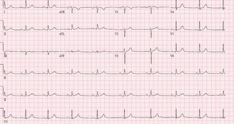 This diagnostic image is a 12-lead electrocardiogram (ECG/EKG) with rhythm strips (II, II, and V5) displayed at the bottom, illustrating a complex cardiac arrhythmia. The key finding is third-degree (complete) atrioventricular (AV) block, characterized by total AV dissociation. P waves are visible and regular (atrial rate), but they bear no consistent temporal relationship to the QRS complexes (ventricular rate), which occur independently. The QRS complexes are widened, measuring >120 ms, and demonstrate a morphology suggestive of an infra-nodal escape rhythm. Notable findings in the precordial leads include absent R-wave progression in V1, V2, and V3, with dominant negative deflections (QS complexes) in these leads. Lead V1 specifically shows a wide, predominantly negative QRS. The underlying ventricular rate is significantly bradycardic compared to the atrial rate. This ECG is a critical educational resource for cardiology, demonstrating the classic findings of complete heart block and the requirement for clinical correlation with hemodynamic stability and potential pacing intervention.