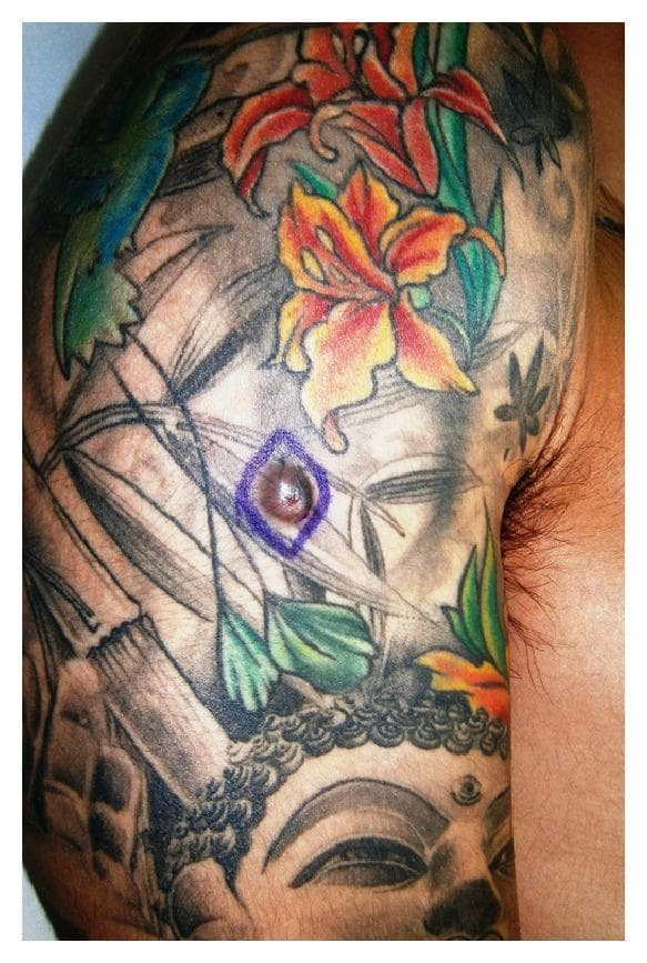 This clinical photograph displays a 10 mm dermatofibroma appearing as a firm, raised, light-red nodular lesion on the right arm of a 21-year-old male. The nodule is specifically localized within the black-pigmented area of an extensive multi-colored tattoo featuring floral, bamboo, and religious iconography. Visually, the lesion is circular with a smooth surface texture and lacks a central punctum or visible ulceration. The surrounding skin shows no acute inflammatory changes or distinct abnormalities apart from the tattoo ink. This image illustrates a potential dermatologic complication arising within tattooed skin, specifically a benign fibrohistiocytic proliferation. Clinically, such lesions are relevant for differential diagnosis against other tattoo-related reactions or malignancies, requiring histopathological confirmation for definitive diagnosis of dermatofibroma.