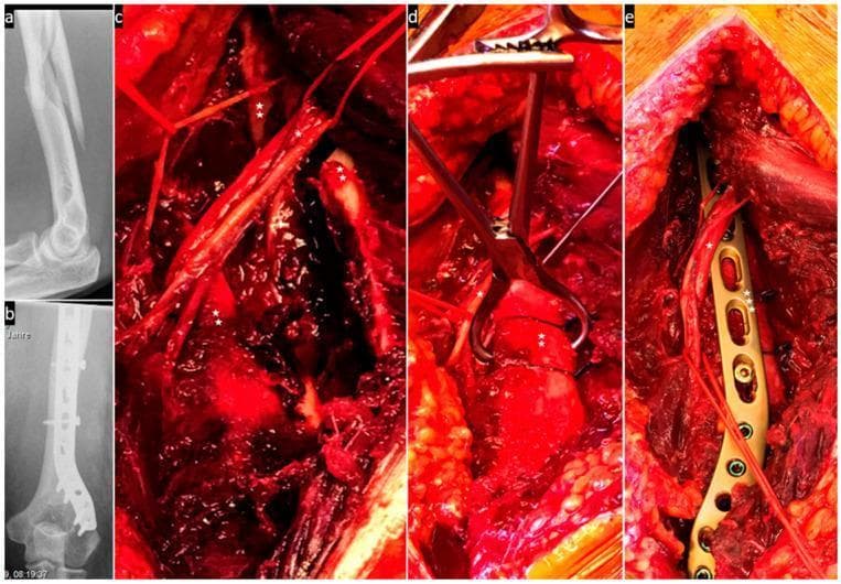 This composite educational image illustrates the surgical management of a humerus fracture with associated radial nerve involvement. (a) Preoperative lateral X-ray displays a displaced, multi-fragmentary humeral shaft fracture. (b) Postoperative X-ray shows internal fixation using a long locking compression plate and screws. (c) Intraoperative clinical photograph via a posterior approach demonstrates the radial nerve (*) being carefully mobilized away from the fracture fragments (**). (d) The fracture is shown undergoing temporary reduction, secured by a reduction clamp and cerclage wires, while the nerve (*) is protected and kept tension-free. (e) Final stabilization phase reveals the radial nerve (*) crossing superficially over the metallic locking plate (***). This sequence highlights key orthopedic principles: anatomical reduction, stable internal fixation, and the critical preservation of neurovascular structures during trauma surgery. The educational focus is on the spatial relationship between orthopedic hardware and the radial nerve to prevent iatrogenic injury during humerus osteosynthesis.