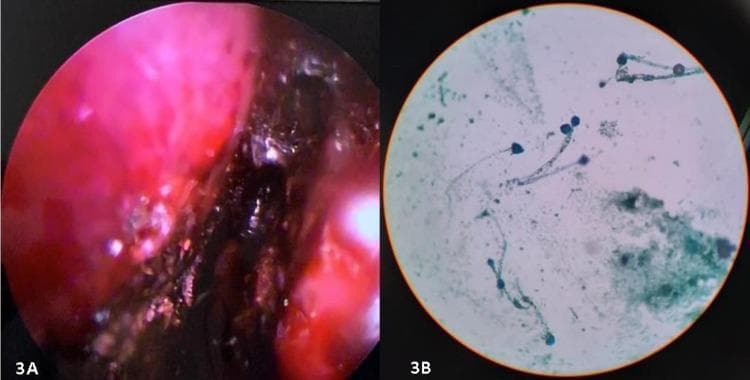 The image consists of two panels demonstrating clinical and laboratory findings associated with invasive fungal sinusitis. Panel A is a diagnostic nasal endoscopy (DNE) photograph showing the right nasal cavity. The mucosa is significantly erythematous and inflamed, featuring extensive dark-brown to black devitalized tissue (eschar) along the turbinates and lateral wall, characteristic of angio-invasive fungal necrosis. Panel B is a bright-field microscopy image of a potassium hydroxide (KOH) mount prepared from a nasal biopsy. It demonstrates fungal elements consistent with Mucorales, characterized by broad, pauciseptate (ribbon-like) hyphae and rounded sporangia/spores. These findings are pedagogically relevant for identifying rhino-orbital-cerebral mucormycosis (ROCM), particularly in immunocompromised or diabetic patients. The combination of visual necrotic tissue (black turbinate sign) and specific fungal morphology provides a comprehensive diagnostic overview of acute invasive fungal infection.